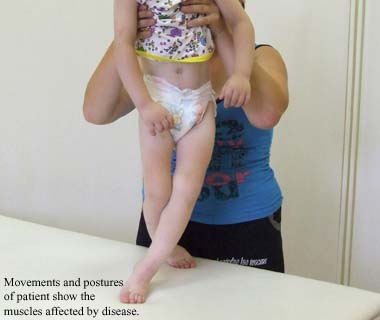 Movements and postures of the patient show the muscles affected by disease.