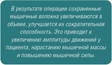 В результате операции сохраненные мышечные волокна увеличиваются в объеме, улучшается их сократительная способность. Это приводит к увеличению амплитуды движений у пациента, нарастанию мышечной массы и повышению мышечной силы
