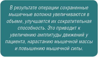 В результате операции сохраненные мышечные волокна увеличиваются в объеме, улучшается их сократительная способность. Это приводит к увеличению амплитуды движений у пациента, нарастанию мышечной массы и повышению мышечной силы